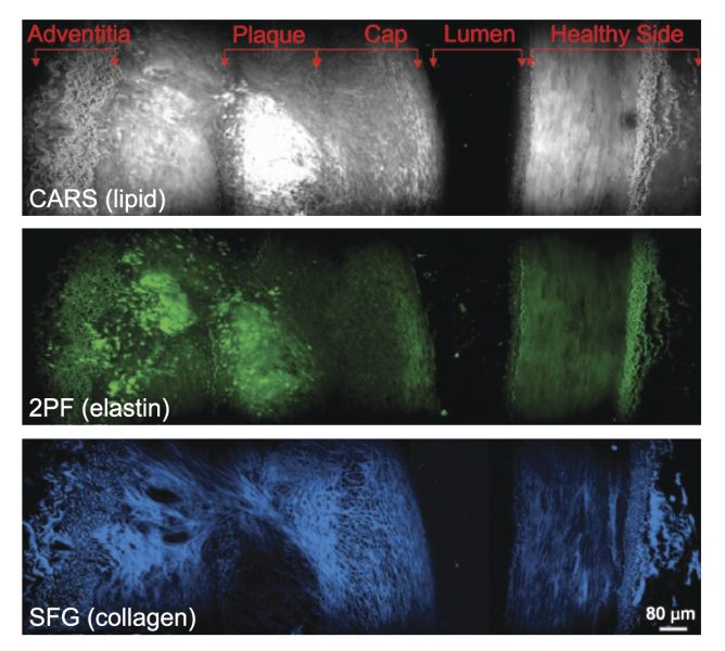 Cross-sectional view of an atherosclerotic plaque demonstrating multi-modal imaging